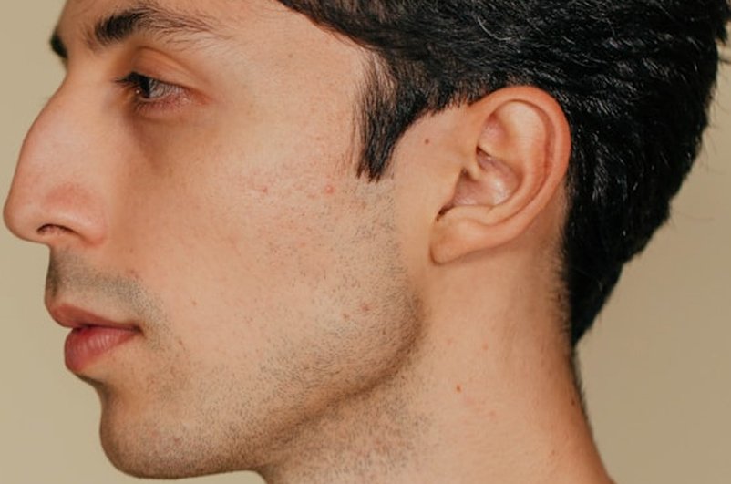 Double Chin Reduction: Reclaim Your Jawline Definition